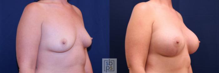 Before & After Breast Augmentation Case 778 Right Oblique View in Los Angeles, Torrance & Long Beach, CA