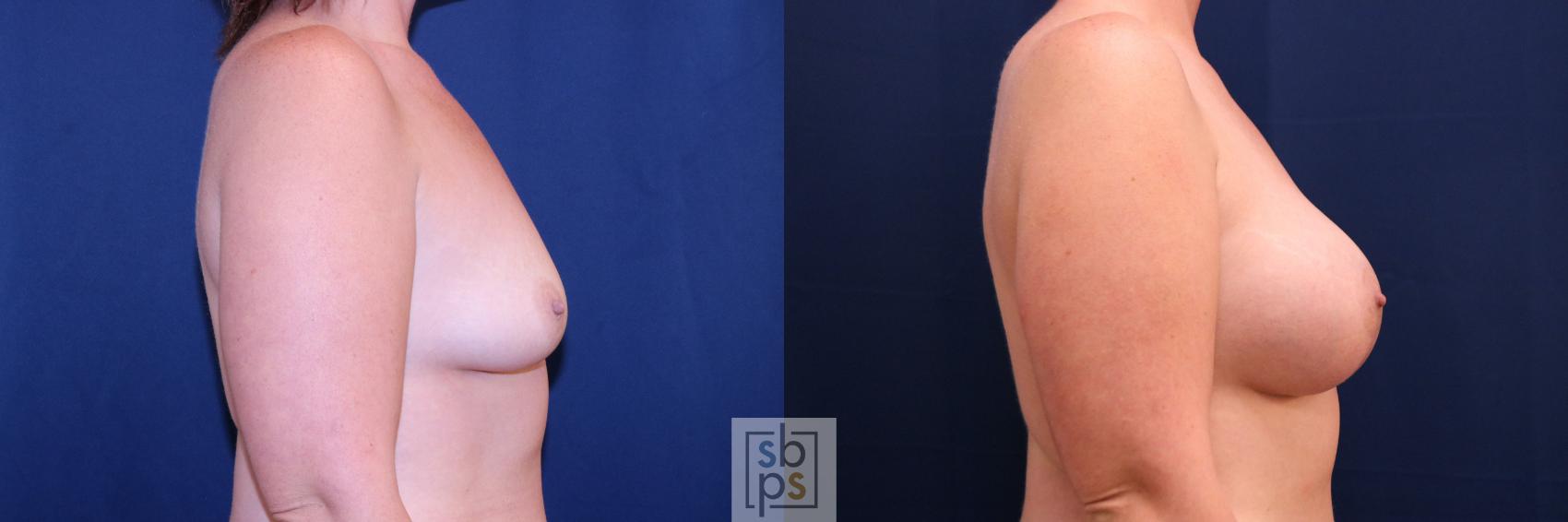 Before & After Breast Augmentation Case 778 Right Side View in Los Angeles, Torrance & Long Beach, CA