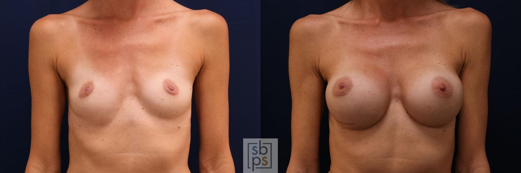 Before & After Breast Augmentation Case 779 Front View in Los Angeles, Torrance & Long Beach, CA