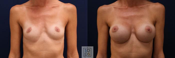Before & After Breast Augmentation Case 779 Front View in Los Angeles, Torrance & Long Beach, CA