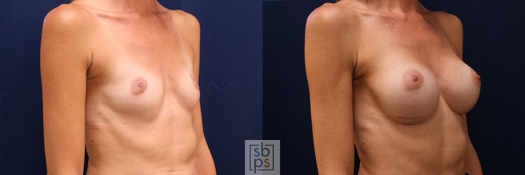 Before & After Breast Augmentation Case 779 Right Oblique View in Los Angeles, Torrance & Long Beach, CA
