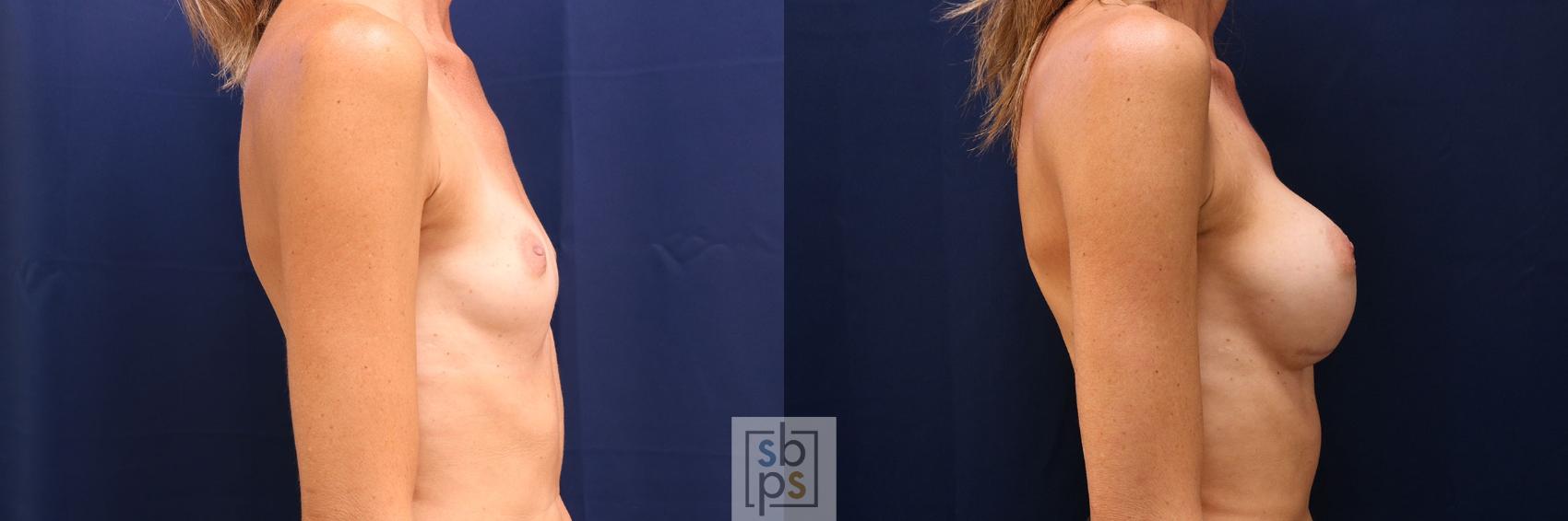 Before & After Breast Augmentation Case 779 Right Side View in Los Angeles, Torrance & Long Beach, CA