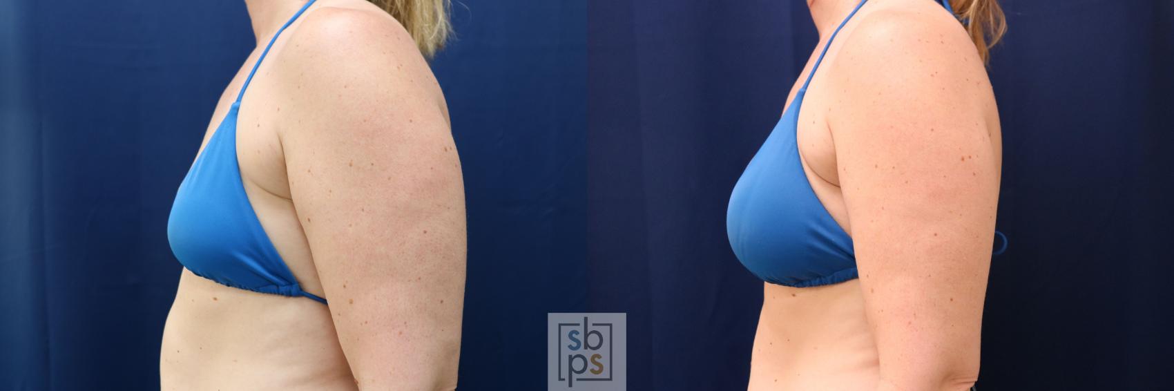 Before & After Breast Augmentation Case 780 Bikini Left View in Los Angeles, Torrance & Long Beach, CA