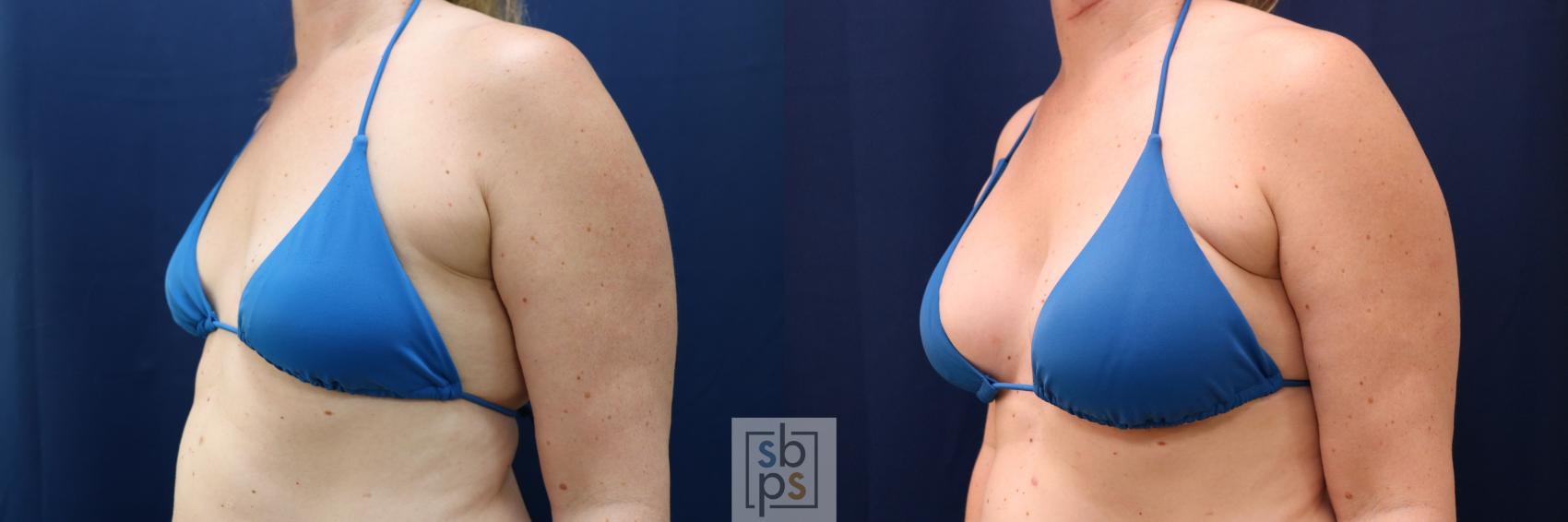 Before & After Breast Augmentation Case 780 Bikini Left Oblique View in Los Angeles, Torrance & Long Beach, CA