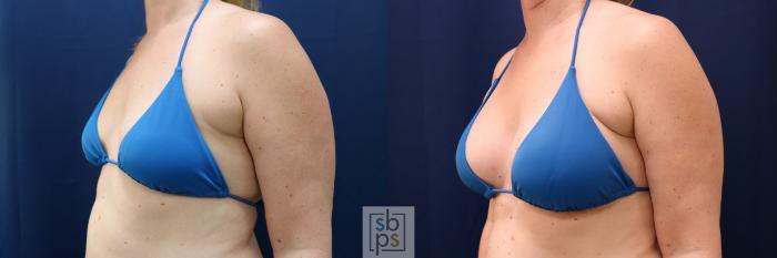 Before & After Breast Augmentation Case 780 Bikini Left Oblique View in Los Angeles, Torrance & Long Beach, CA