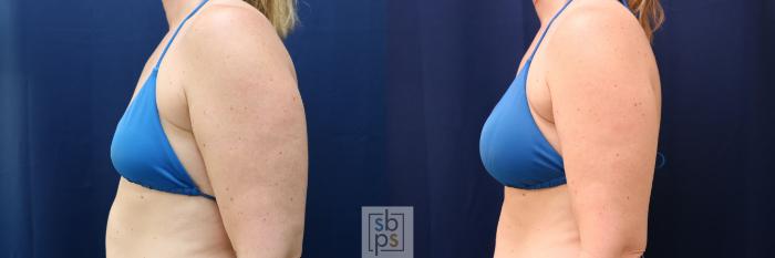 Before & After Breast Augmentation Case 780 Bikini Left View in Los Angeles, Torrance & Long Beach, CA