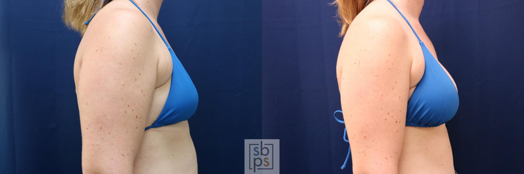 Before & After Breast Augmentation Case 780 Bikini Right View in Los Angeles, Torrance & Long Beach, CA