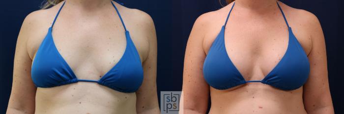 Before & After Breast Augmentation Case 780 Bikini View in Los Angeles, Torrance & Long Beach, CA
