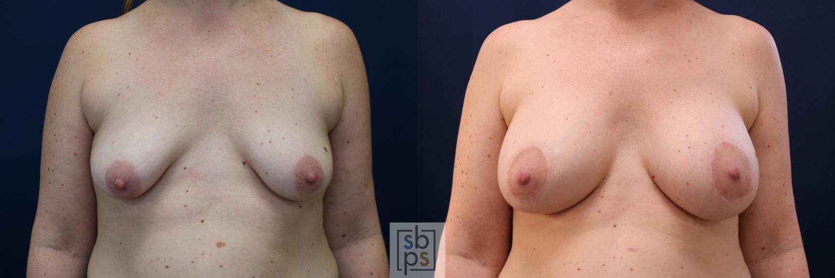 Before & After Breast Augmentation Case 780 Front View in Los Angeles, Torrance & Long Beach, CA
