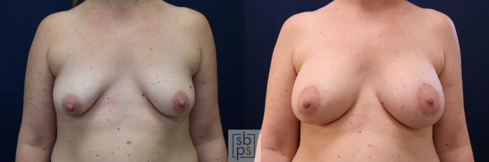 Before & After Breast Augmentation Case 780 Front View in Los Angeles, Torrance & Long Beach, CA