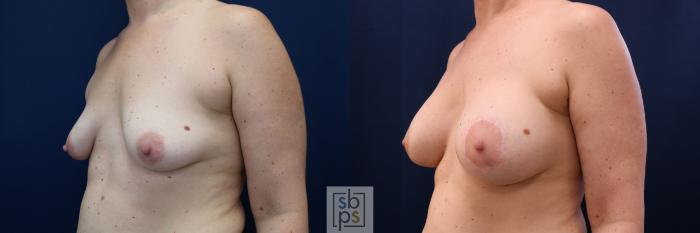 Before & After Breast Augmentation Case 780 Left Oblique View in Los Angeles, Torrance & Long Beach, CA