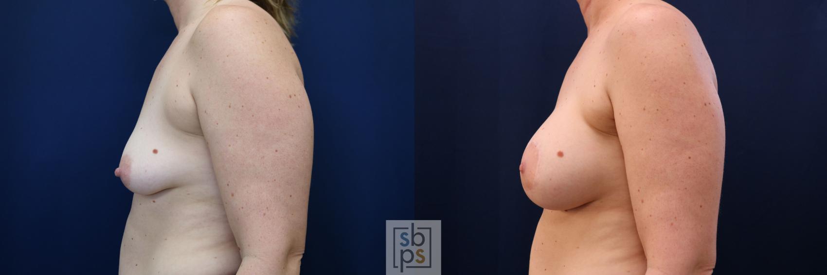 Before & After Breast Augmentation Case 780 Left Side View in Los Angeles, Torrance & Long Beach, CA