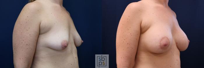 Before & After Breast Augmentation Case 780 Right Oblique View in Los Angeles, Torrance & Long Beach, CA