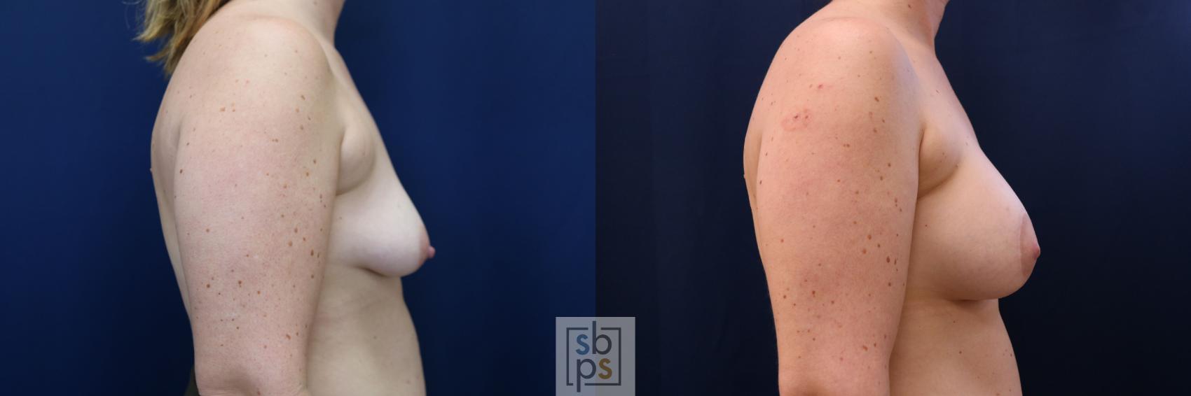 Before & After Breast Augmentation Case 780 Right Side View in Los Angeles, Torrance & Long Beach, CA