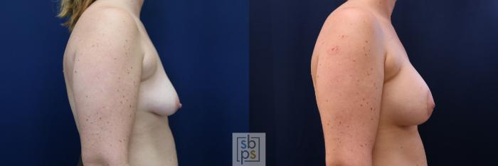 Before & After Breast Augmentation Case 780 Right Side View in Los Angeles, Torrance & Long Beach, CA