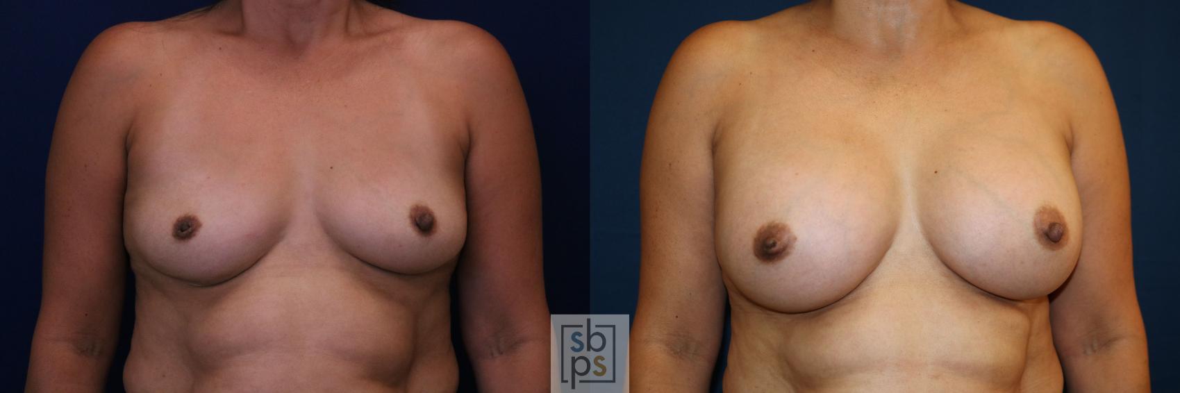 Before & After Breast Augmentation Case 781 Front View in Los Angeles, Torrance & Long Beach, CA