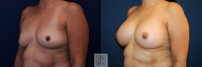 Before & After Breast Augmentation Case 781 Left Oblique View in Los Angeles, Torrance & Long Beach, CA