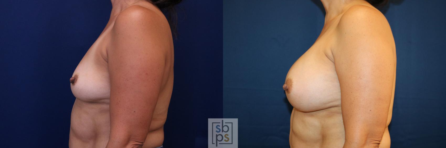 Before & After Breast Augmentation Case 781 Left Side View in Los Angeles, Torrance & Long Beach, CA