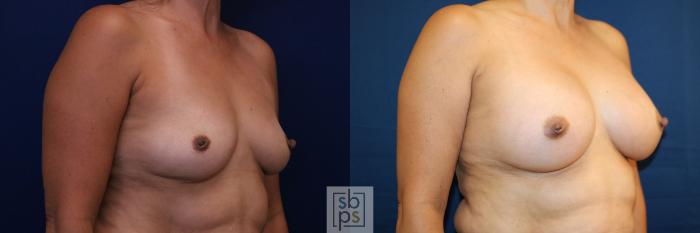 Before & After Breast Augmentation Case 781 Right Oblique View in Los Angeles, Torrance & Long Beach, CA