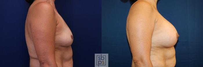 Before & After Breast Augmentation Case 781 Right Side View in Los Angeles, Torrance & Long Beach, CA
