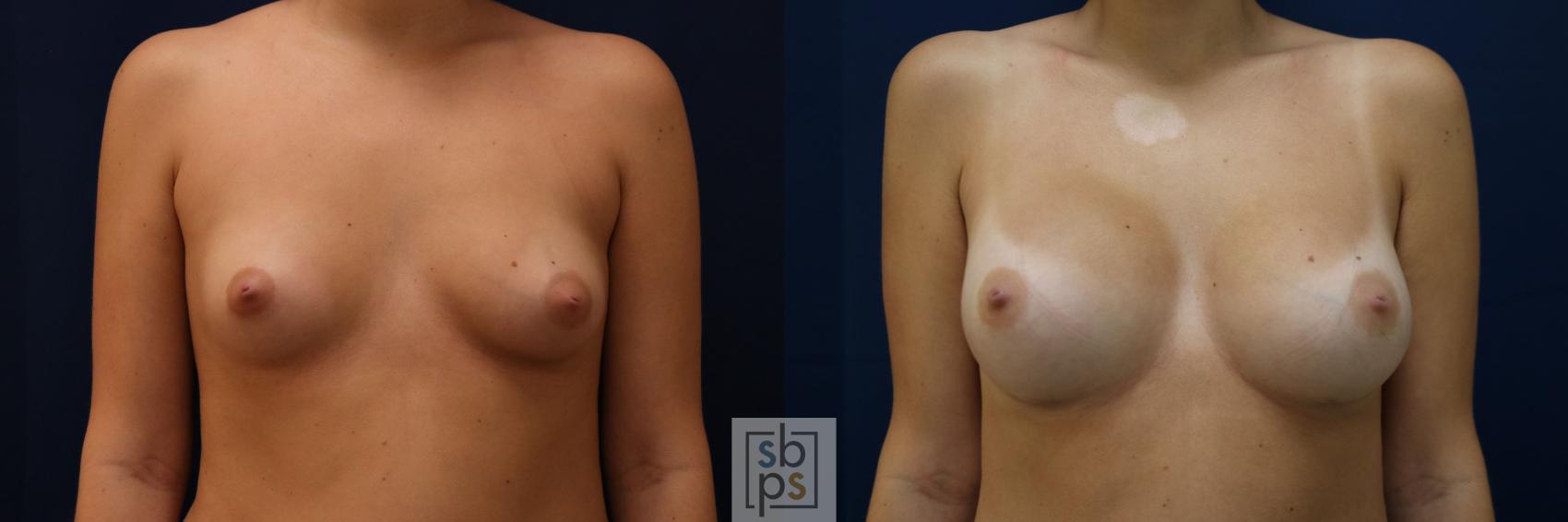 Before & After Breast Augmentation Case 782 Front View in Los Angeles, Torrance & Long Beach, CA