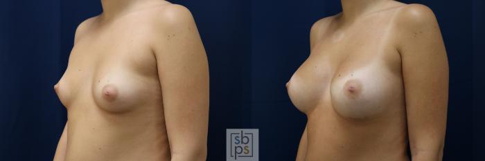 Before & After Breast Augmentation Case 782 Left Oblique View in Los Angeles, Torrance & Long Beach, CA