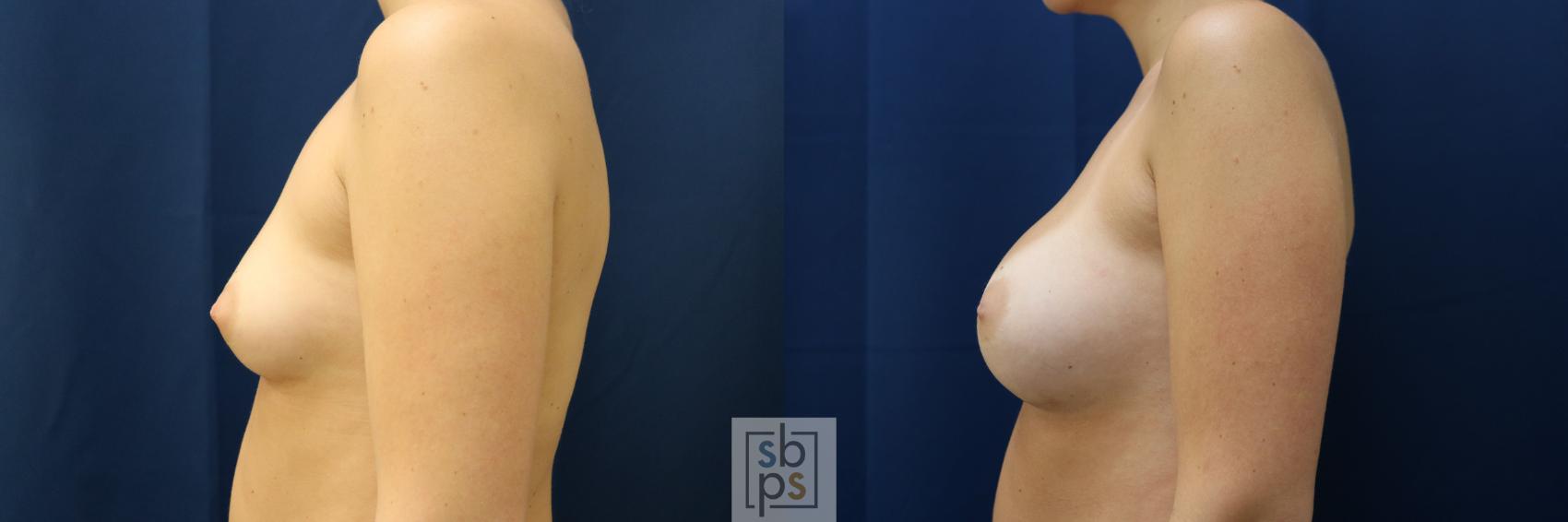 Before & After Breast Augmentation Case 782 Left Side View in Los Angeles, Torrance & Long Beach, CA