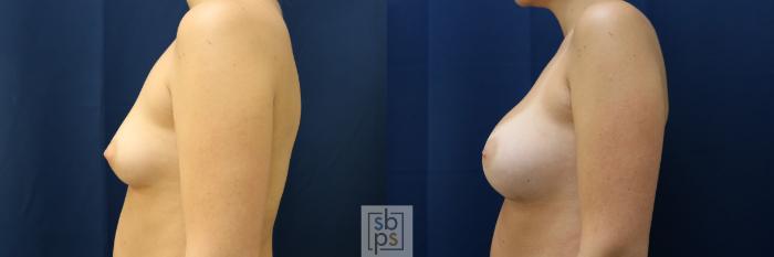 Before & After Breast Augmentation Case 782 Left Side View in Los Angeles, Torrance & Long Beach, CA