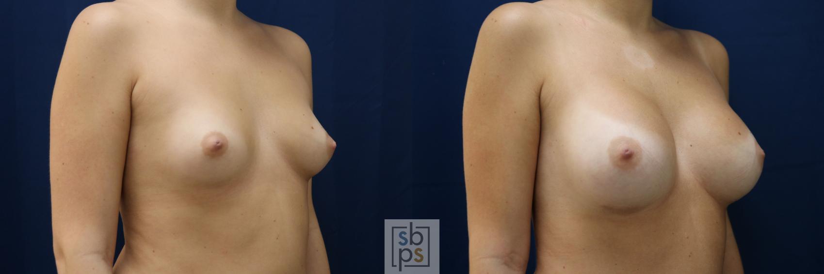 Before & After Breast Augmentation Case 782 Right Oblique View in Los Angeles, Torrance & Long Beach, CA