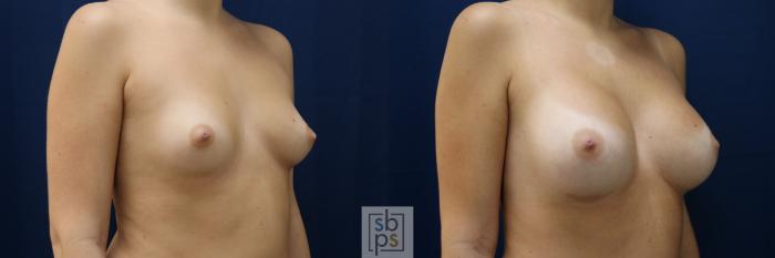 Before & After Breast Augmentation Case 782 Right Oblique View in Los Angeles, Torrance & Long Beach, CA