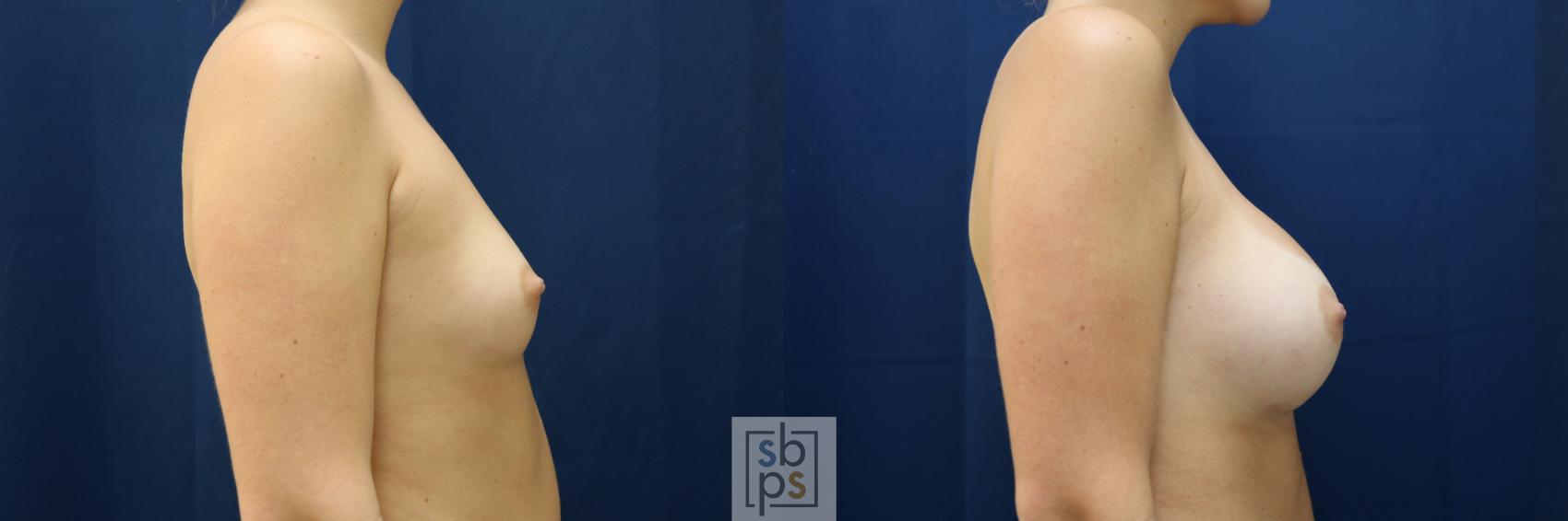 Before & After Breast Augmentation Case 782 Right Side View in Los Angeles, Torrance & Long Beach, CA