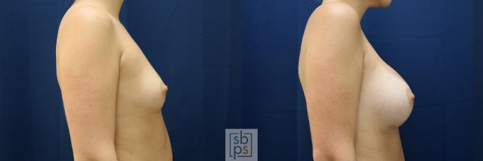Before & After Breast Augmentation Case 782 Right Side View in Los Angeles, Torrance & Long Beach, CA