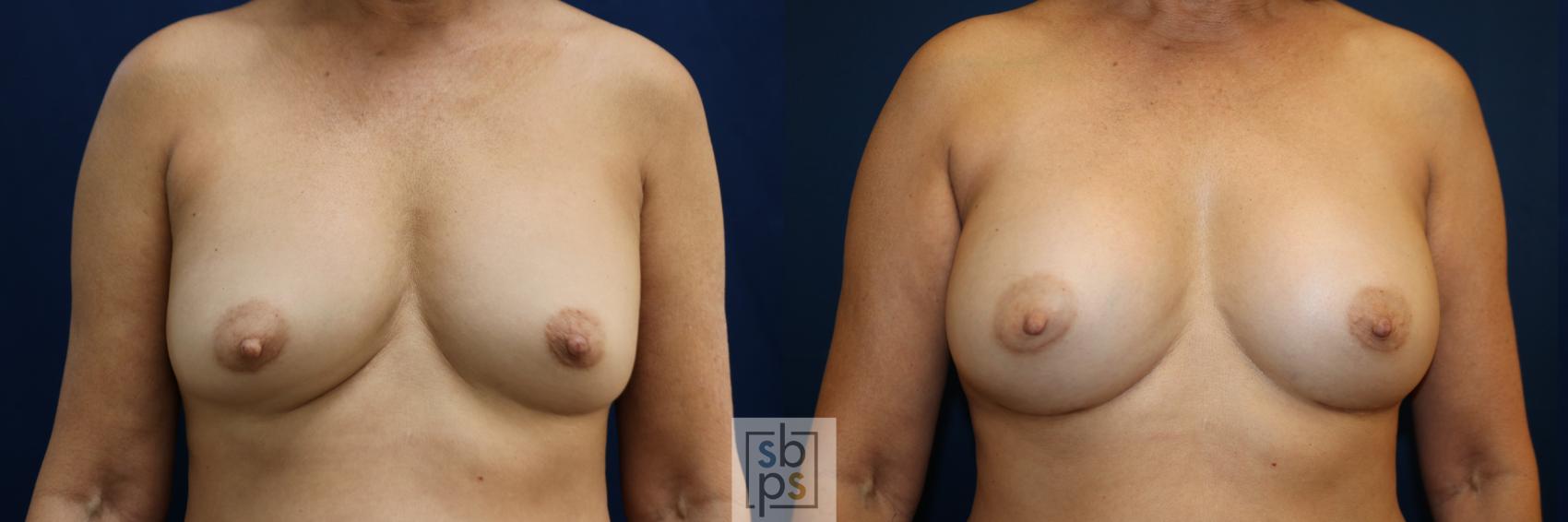 Before & After Breast Augmentation Case 783 Front View in Los Angeles, Torrance & Long Beach, CA