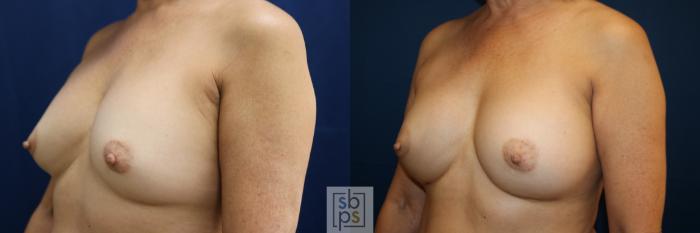 Before & After Breast Augmentation Case 783 Left Oblique View in Los Angeles, Torrance & Long Beach, CA