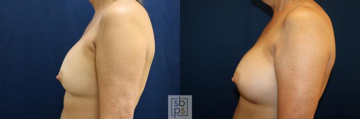 Before & After Breast Augmentation Case 783 Left Side View in Los Angeles, Torrance & Long Beach, CA