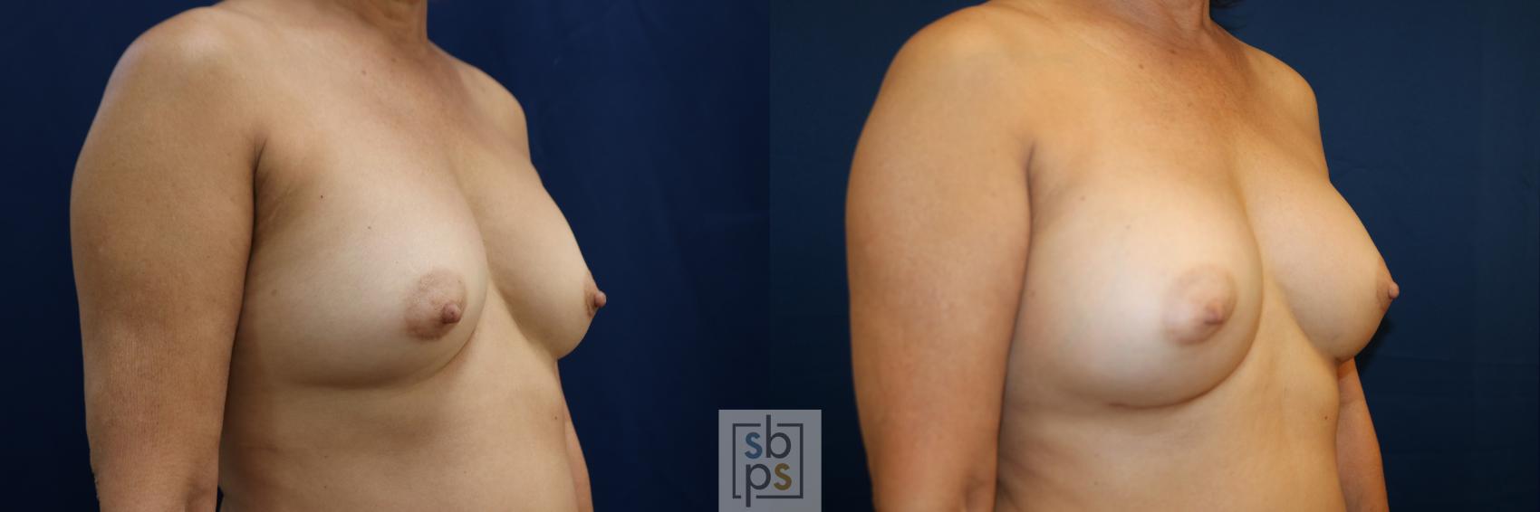 Before & After Breast Augmentation Case 783 Right Oblique View in Los Angeles, Torrance & Long Beach, CA