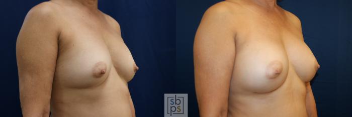 Before & After Breast Augmentation Case 783 Right Oblique View in Los Angeles, Torrance & Long Beach, CA