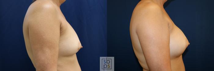 Before & After Breast Augmentation Case 783 Right Side View in Los Angeles, Torrance & Long Beach, CA
