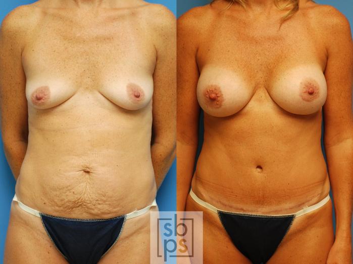 Before & After Breast Augmentation Case 79 View #1 View in Torrance, CA