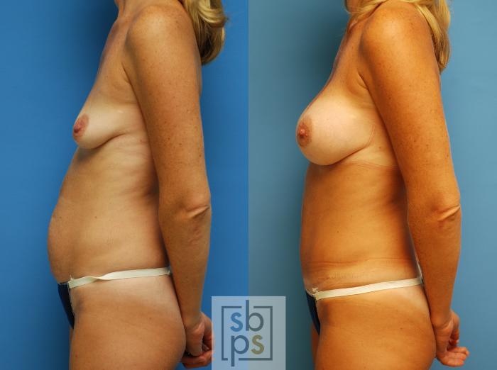 Before & After Tummy Tuck Case 79 View #2 View in Torrance, CA