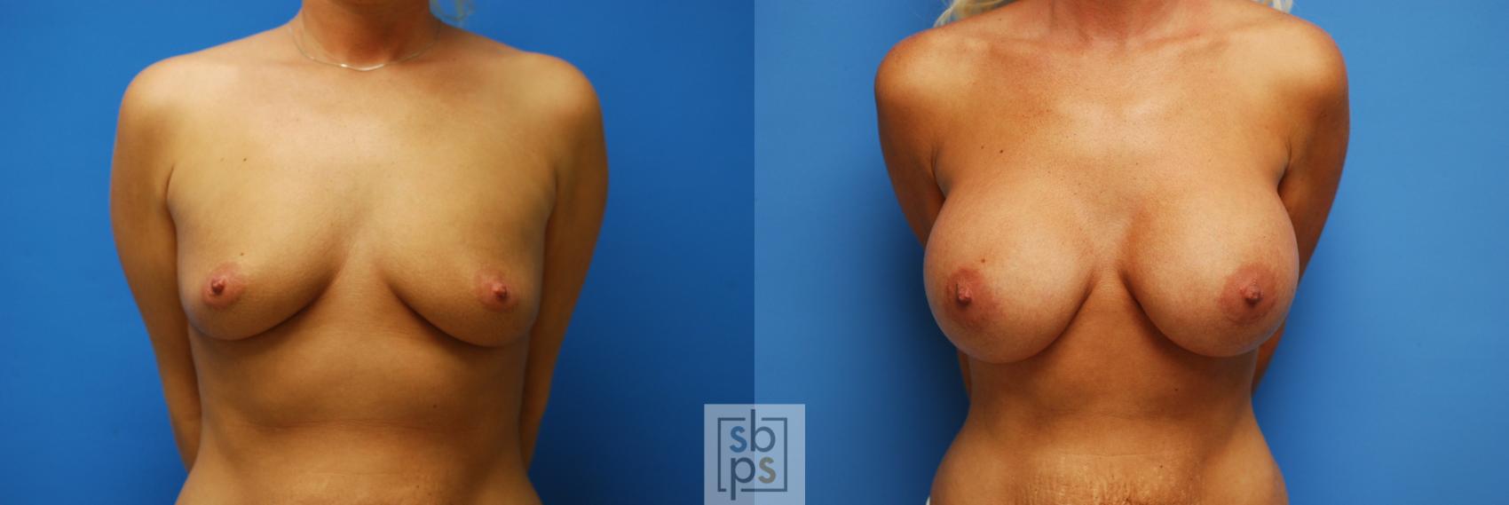 Before & After Breast Augmentation Case 83 View #1 View in Torrance, CA