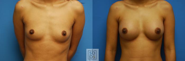 Before & After Breast Augmentation Case 84 View #1 View in Torrance, CA