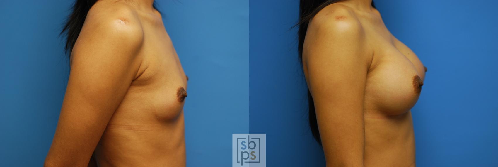 Before & After Breast Augmentation Case 84 View #2 View in Torrance & Los Angeles, CA, CA