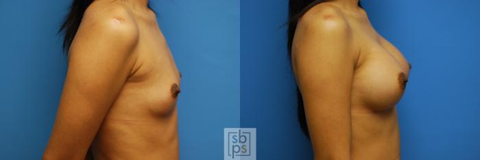 Before & After Breast Augmentation Case 84 View #2 View in Torrance, CA