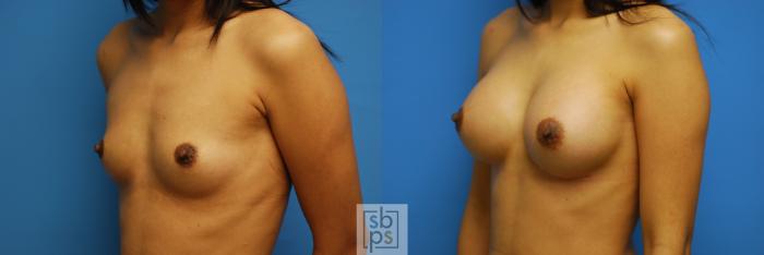 Before & After Breast Augmentation Case 84 View #4 View in Torrance, CA