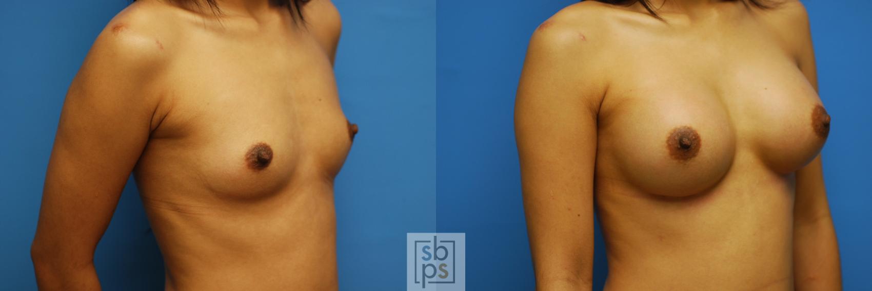 Before & After Breast Augmentation Case 84 View #5 View in Torrance, CA