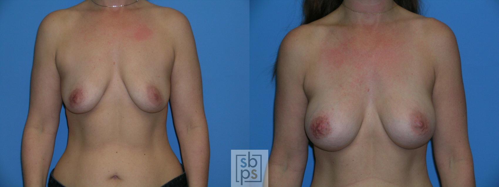 Before & After Breast Augmentation Case 88 View #1 View in Torrance, CA