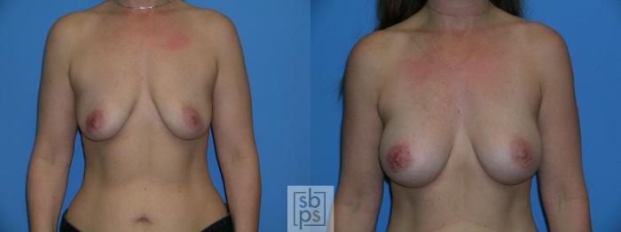 Before & After Breast Augmentation Case 88 View #1 View in Torrance, CA