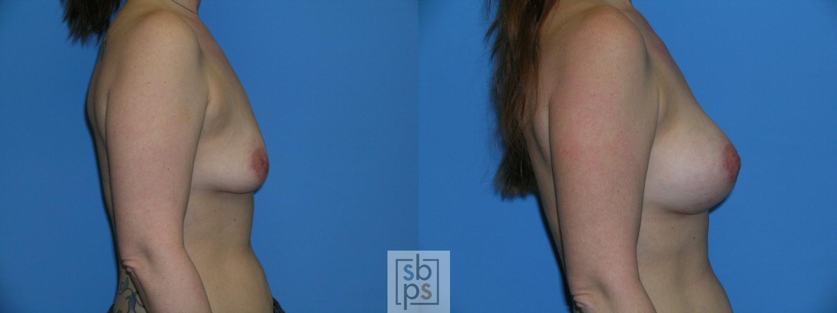 Before & After Breast Augmentation Case 88 View #2 View in Torrance & Los Angeles, CA, CA