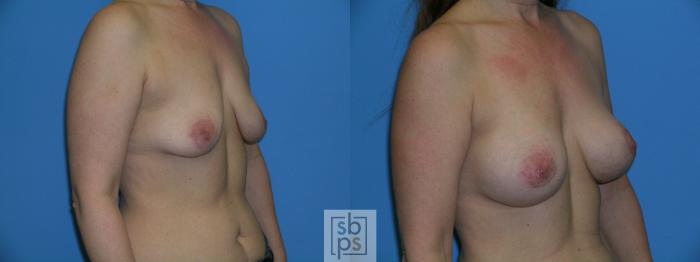 Before & After Breast Augmentation Case 88 View #3 View in Torrance, CA